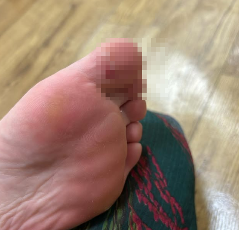 발에 무리가 가서 생긴 물집